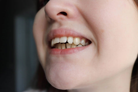 Overbite Explained: Causes, Effects, and How Clear Aligners Can Fix It