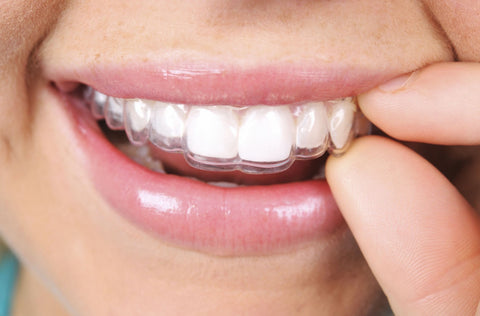 From Impressions to Perfect Smile: The Step-by-Step Journey of UK Clear Aligner Treatment