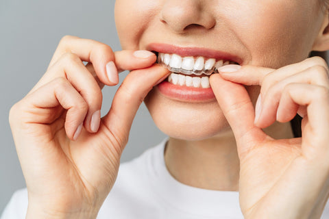 Your First 30 Days with Smileie Aligners: What Really Happens?