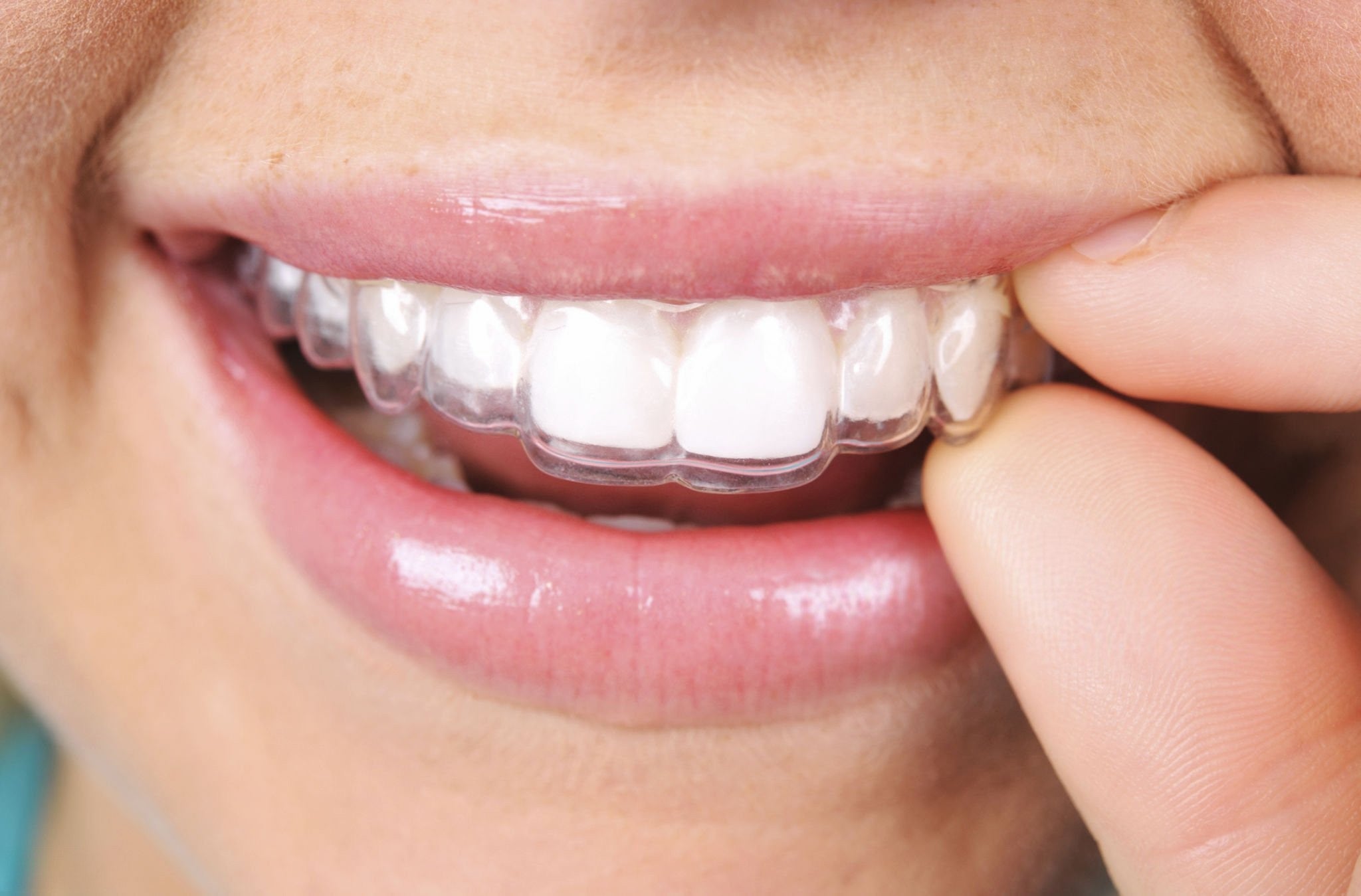 From Impressions to Perfect Smile: The Step-by-Step Journey of UK Clear Aligner Treatment
