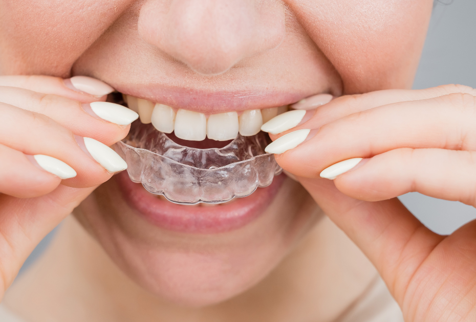 Woman fitting an invisible clear aligner tray over her teeth – clear aligners near me in the UK