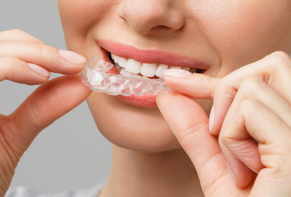 Person placing clear aligners over teeth to start invisible orthodontic treatment in the UK