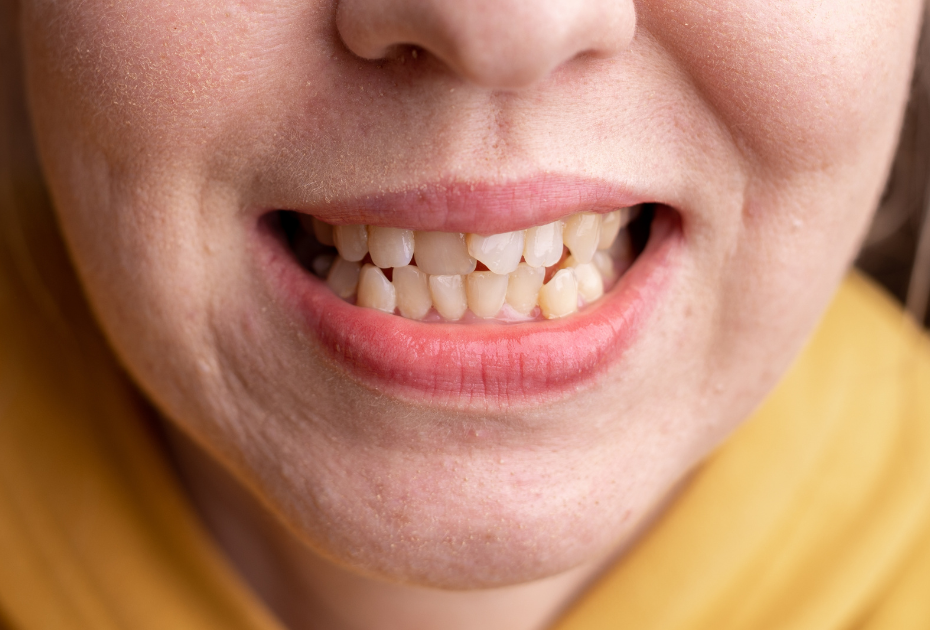 Close-up of woman smiling with slightly crooked teeth before starting clear aligners UK treatment.