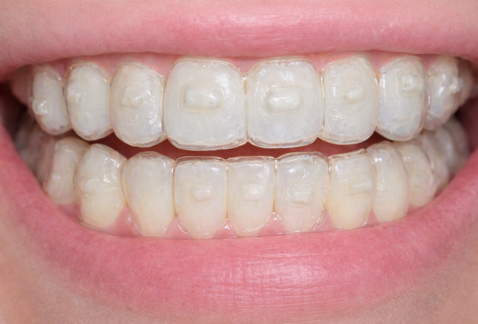 Close-up of teeth wearing clear aligners with tooth-coloured aligner attachments visible on upper and lower front teeth.