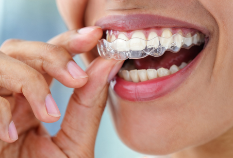 Looking for Clear Aligners Near Me? A Simple UK Guide to Getting Started