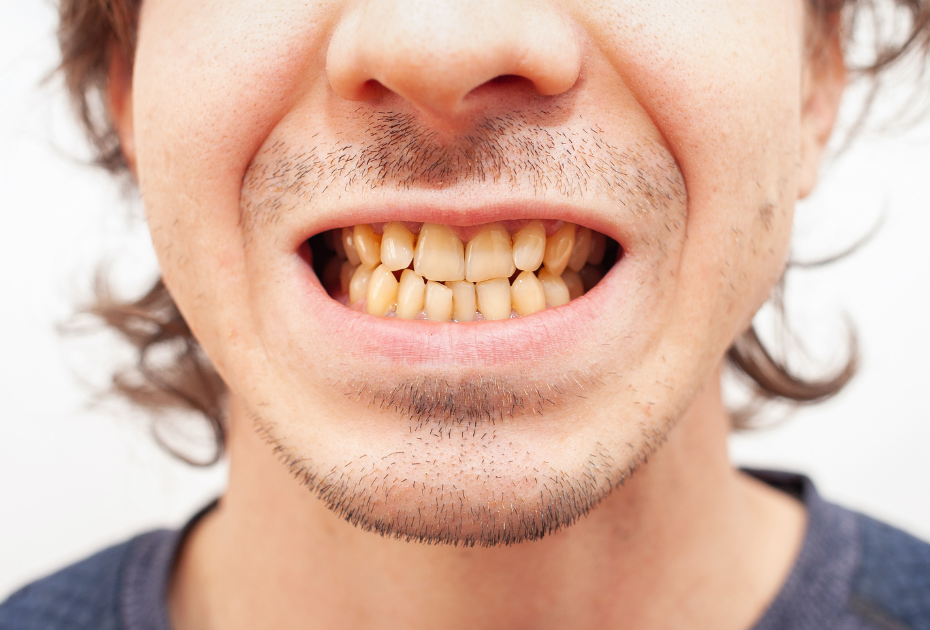 Close-up of crowded teeth with overlapping front teeth suitable for clear aligner treatment.