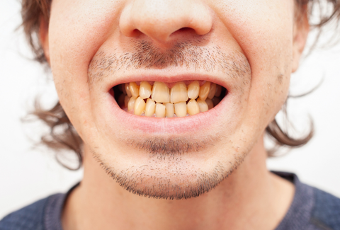 Can Clear Aligners Fix Crowded Teeth?