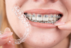 Should You Choose Clear Aligners or Braces?