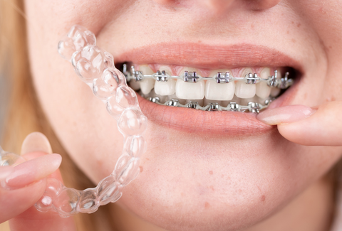 Clear Aligners vs Braces Cost in the UK: Which Gives Better Value?