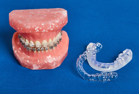 Should You Choose Clear Aligners or Braces?