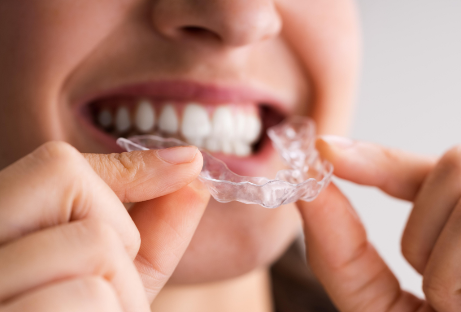Clear aligner being held and placed onto teeth for invisible teeth straightening treatment in the UK.