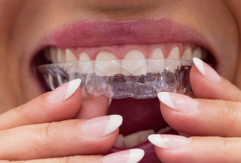 Why New Aligners Feel Tight at First