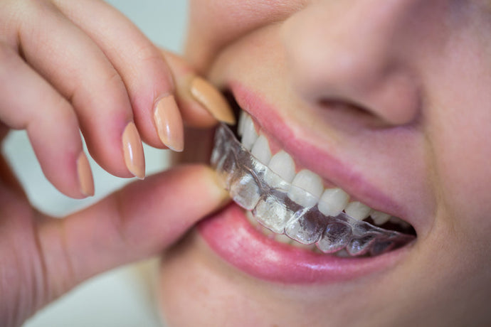 Are At-Home Teeth Aligners Safe? What You Need to Know