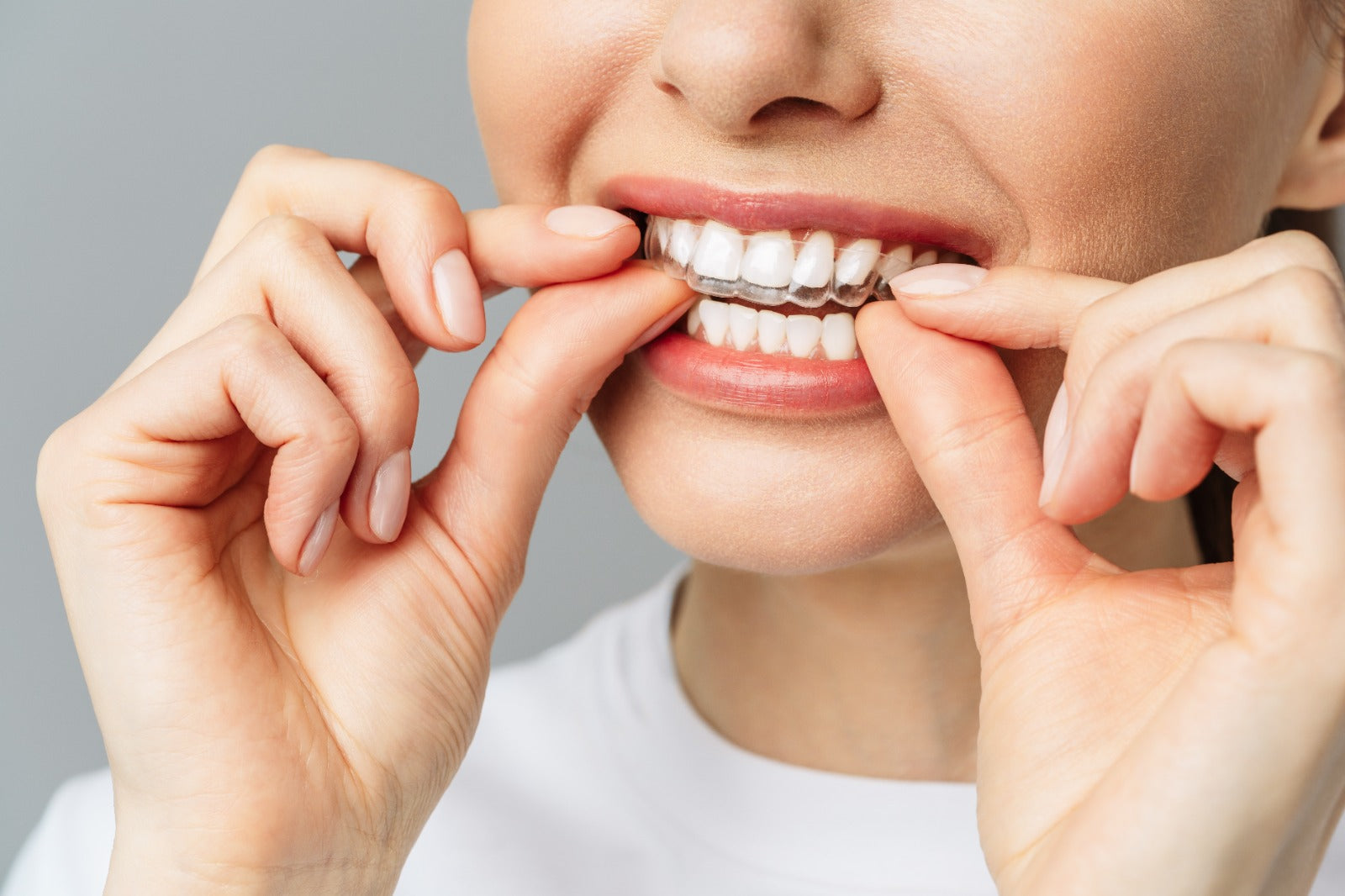 Your First 30 Days with Smileie Aligners: What Really Happens?