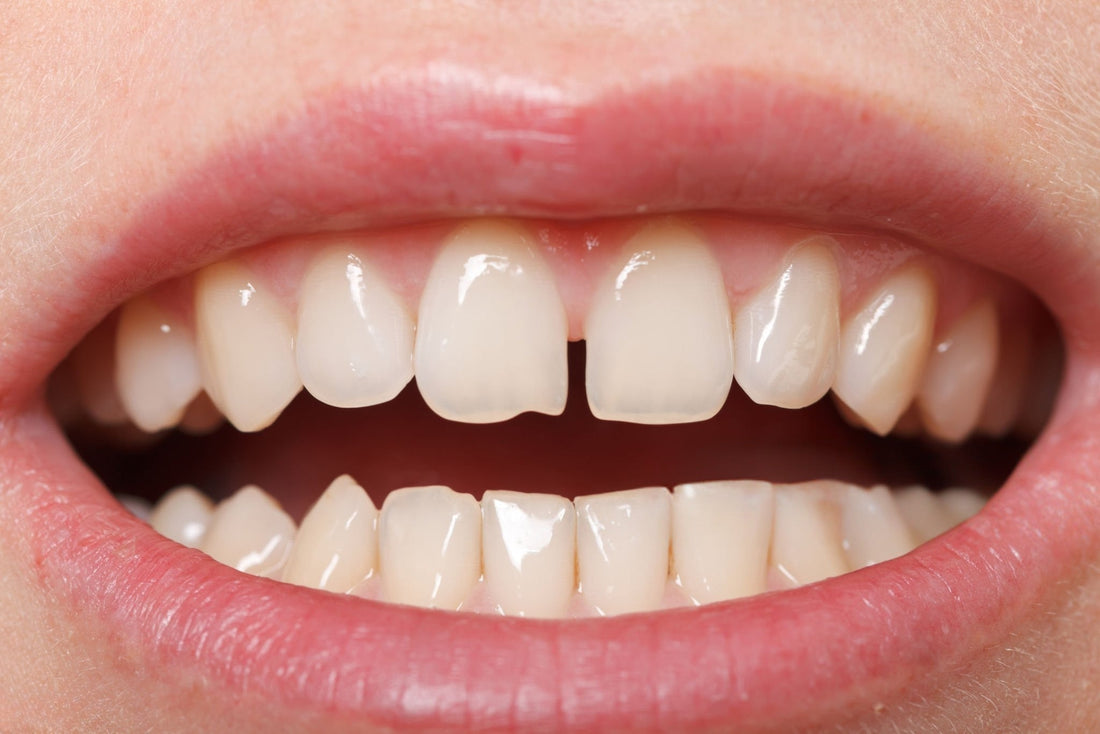 Can Smileie Clear Aligners Fix Gap Teeth? UK Diastema Guide