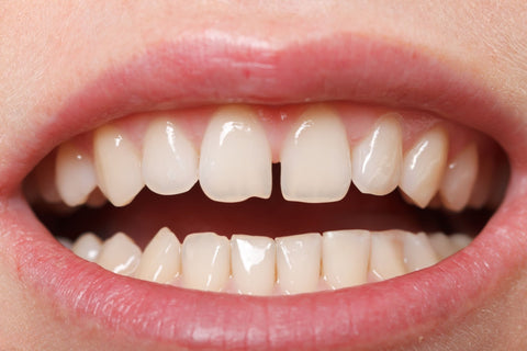 Can Smileie Clear Aligners Fix Gap Teeth? UK Diastema Guide