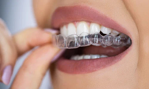 Smileie Pro Dual Arch Installment